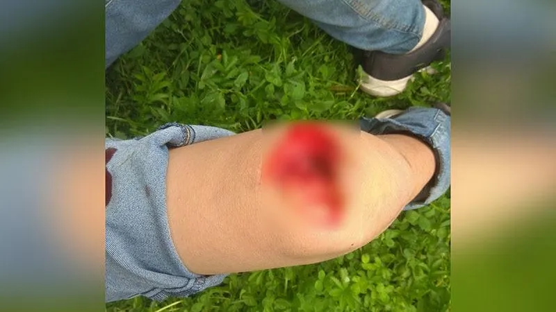 Мальчику прооперировали ногу после инцидента на детской площадке в Химках