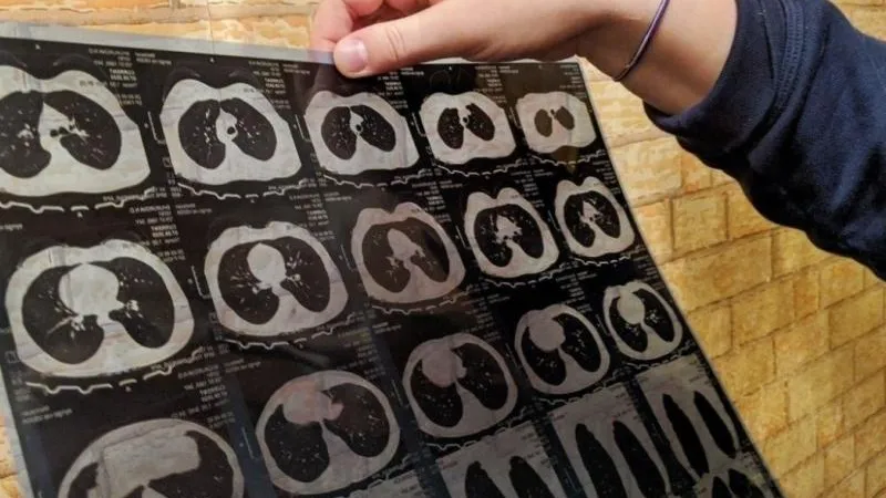 Ученые рассказали, что коронавирус повреждает мозг