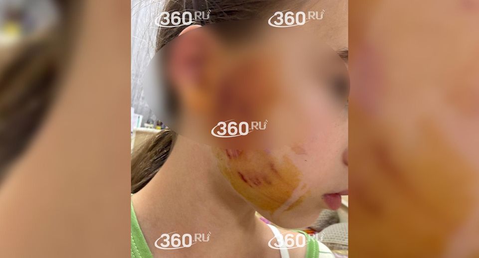 В Калининграде бойцовский пес набросился на девочку на глазах у прохожих