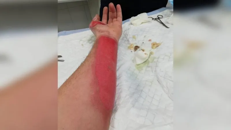 Мужчина обварил руку кипятком из-под крана в Пушкино