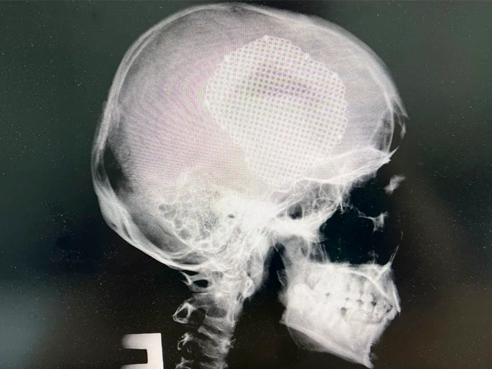 «Догадаться невозможно»: подмосковные нейрохирурги установили в череп пациента особую пластину