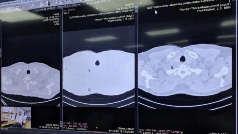 На 19,2% снизилась смертность от туберкулеза в Подмосковье в 2019 году
