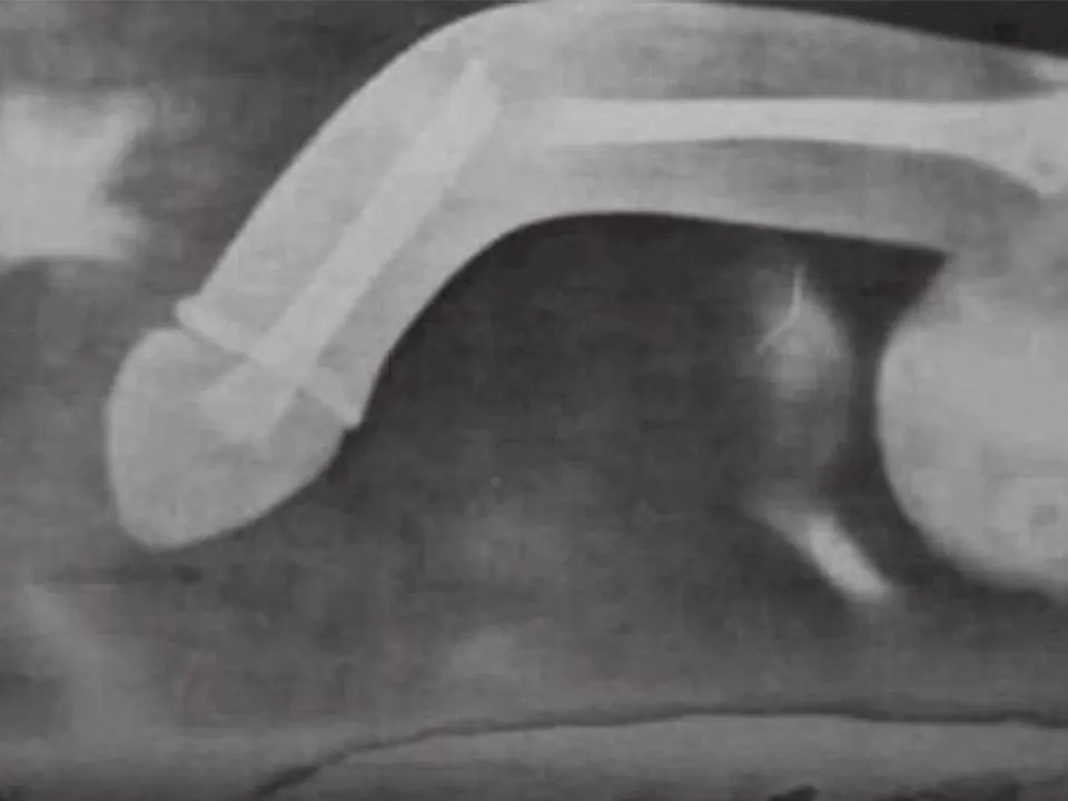 «Человек должен прекратить сексуальную жизнь»: уролог раскрыл, чем опасен перелом пениса