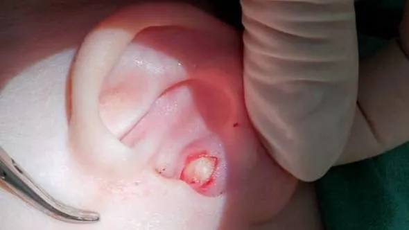 Врачи в Видном удалили кисту из уха годовалой девочке