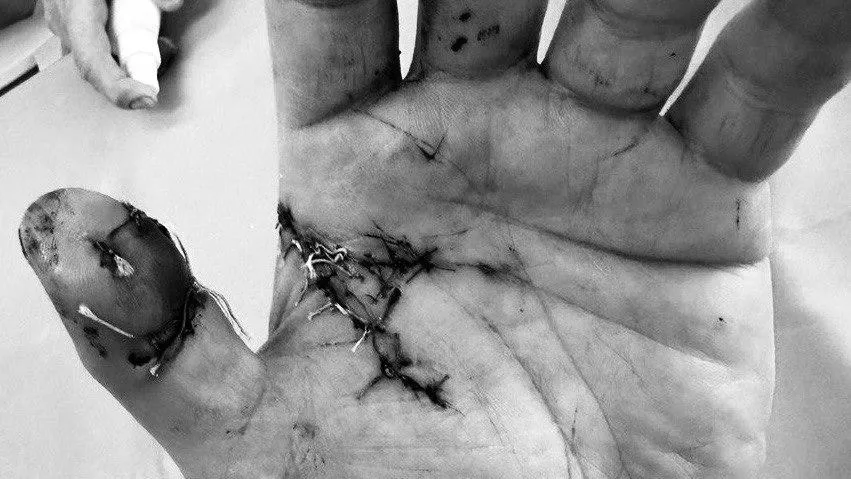 Врачи в Чехове спасли пациента, получившего травму из-за тарелки