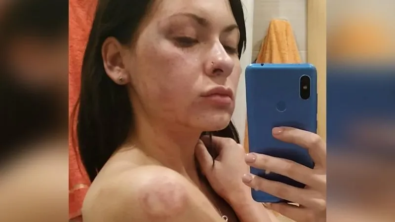 26-летнюю жительницу Клина жестоко избил ее парень