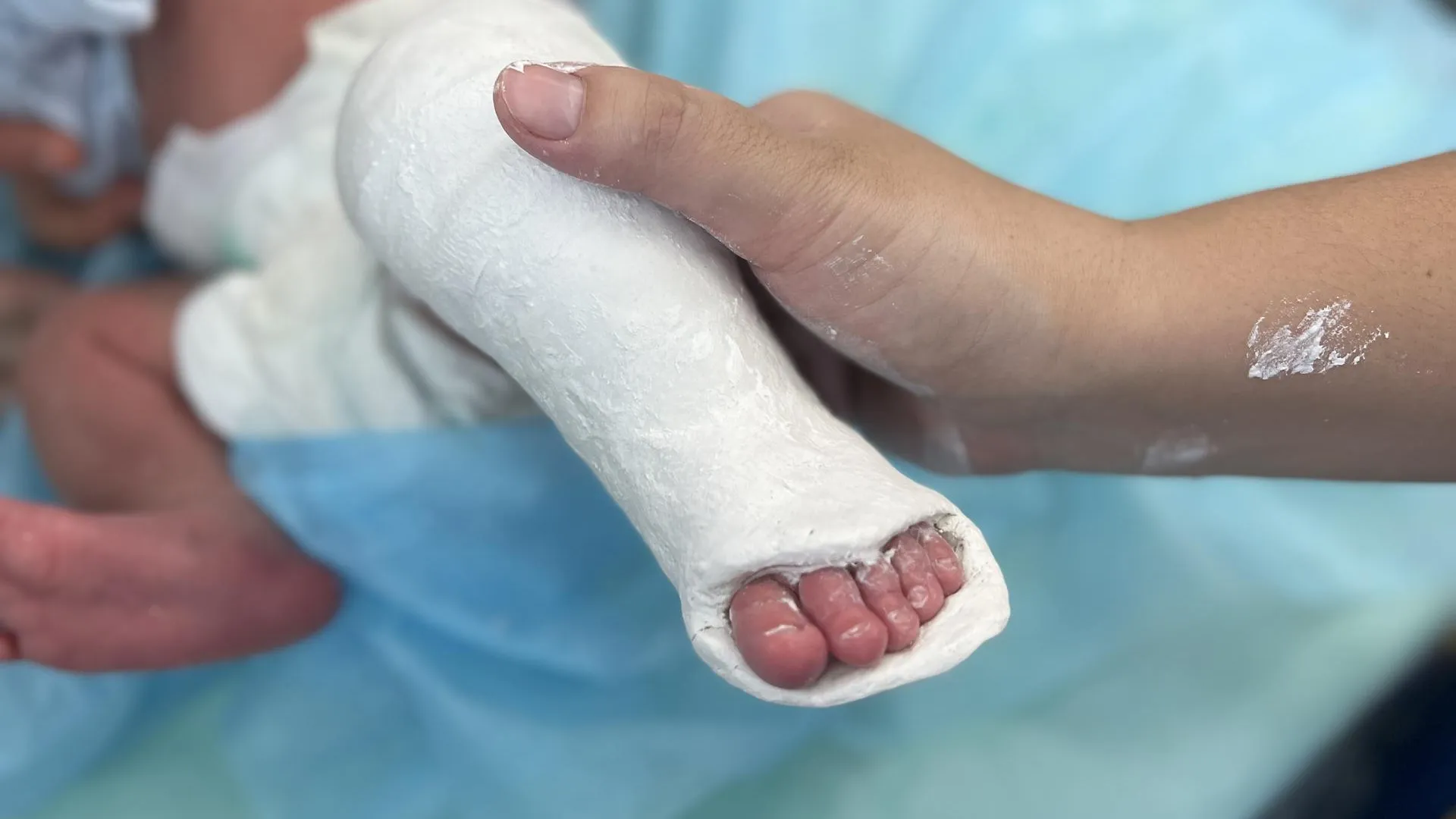 Подмосковные травматологи напомнили ключевые методы лечения детской косолапости