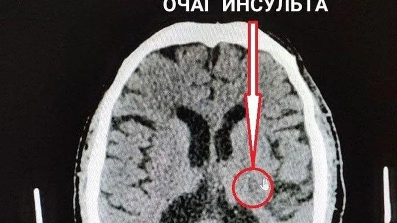 Врачи из Коломны за считанные минуты спасли от инсульта 68-летнего пациента