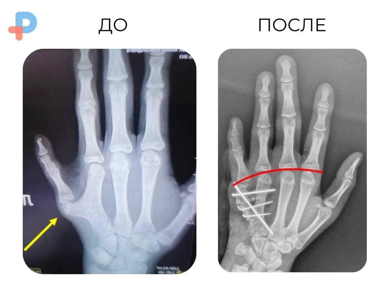 Подмосковные ортопеды восстановили кисть ребенку с врожденной аномалией