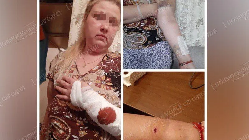 Жертва нападения в Мытищах: автохам спустил на меня бойцового пса и выдрал волосы