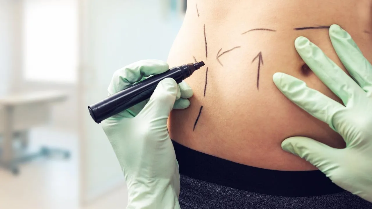 Удаление жира может убить: хирург рассказал о страшных последствиях липосакции