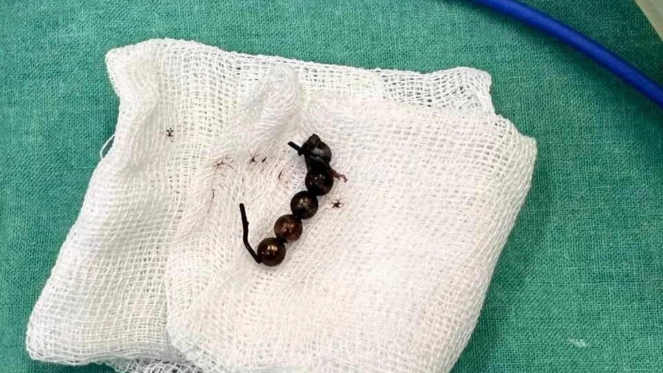 В Московской области спасли подростка, проглотившего магнитные шарики