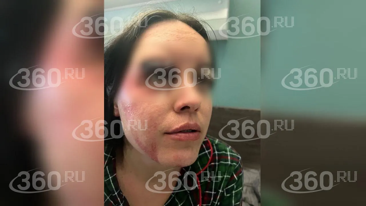 На фото Анастасия Лобода после операции по пересадке кожи в сентябре 2025 года