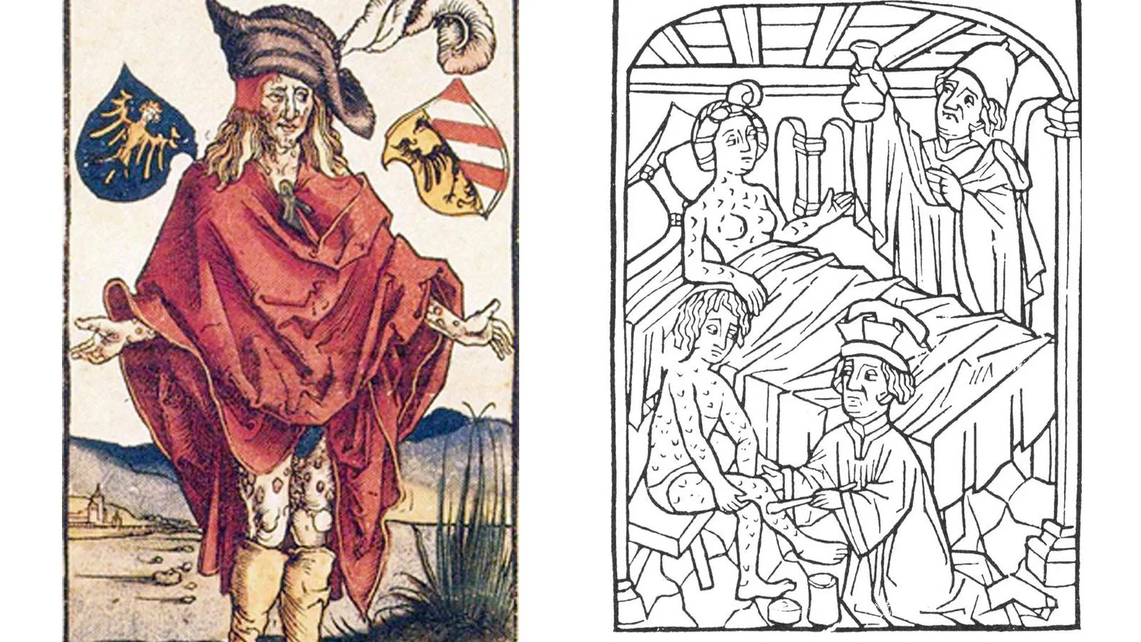 Больной сифилисом по версии Альбрехта Дюрера, 1496 год; лечение больных со вторичным сифилисом в средневековье, 1522 год