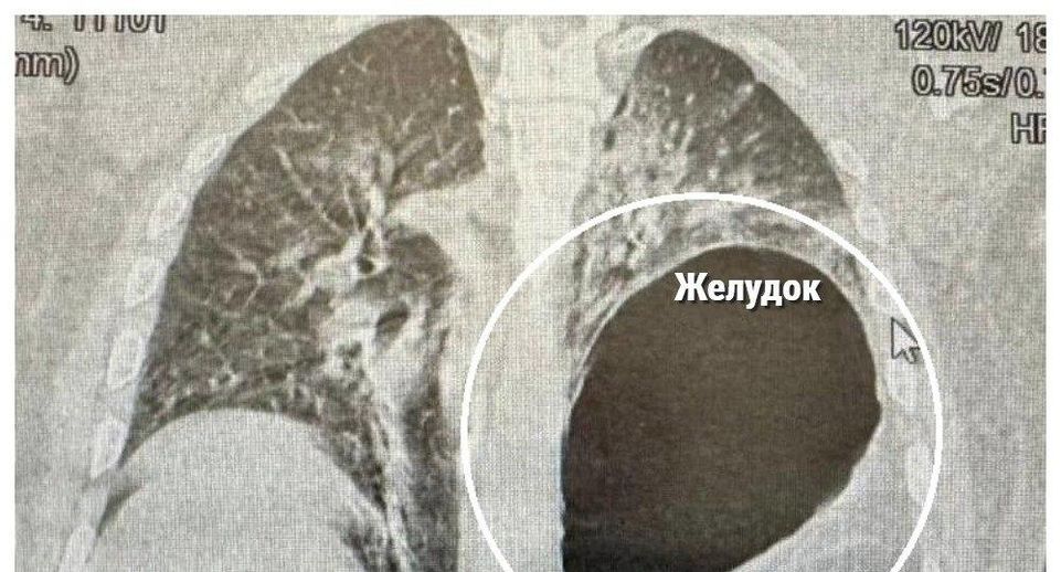 Мужчину со смещением органов после падения спасли в Истре
