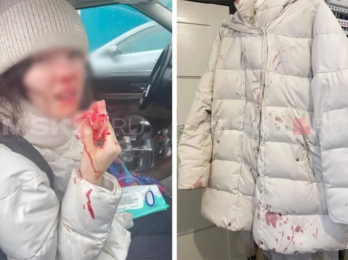 Школьница травмировала нос из-за гололеда в Химках. Власти ответили на обвинения