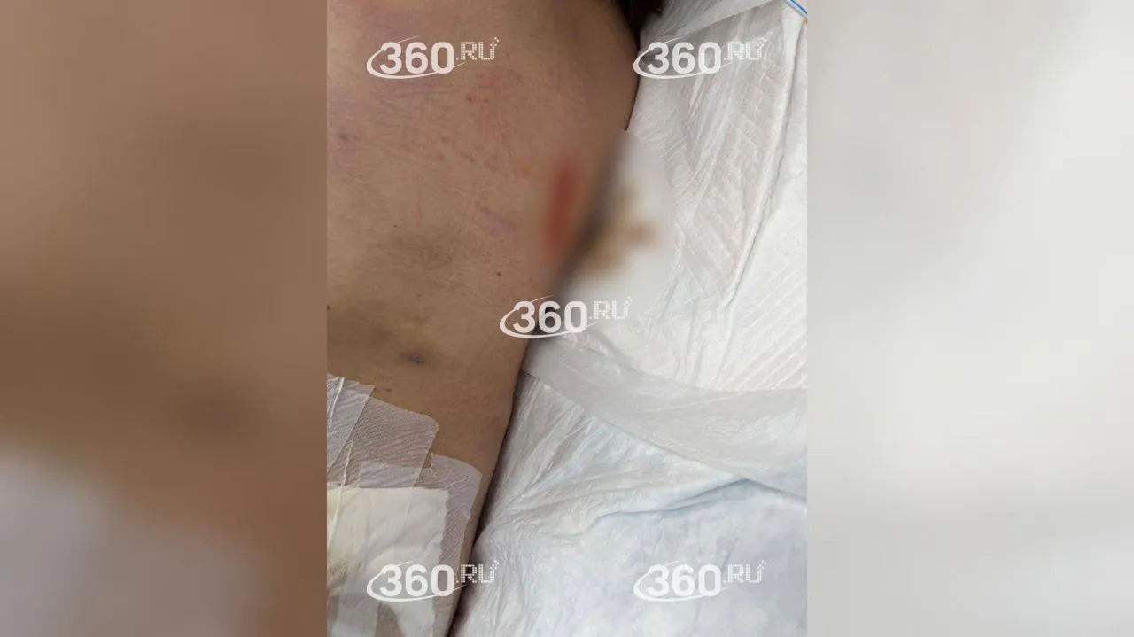 Тяжело пострадавший пациент рехаба в Дедовске. Сейчас мальчик в коме