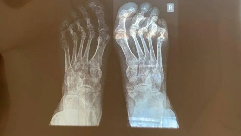 Врачи в Красногорске вернули пациентке со сложной деформацией стоп возможность ходить