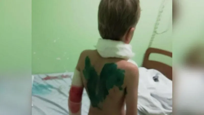 Врачи спасают 8-летнего мальчика после нападения деревенского пса под Дмитровом