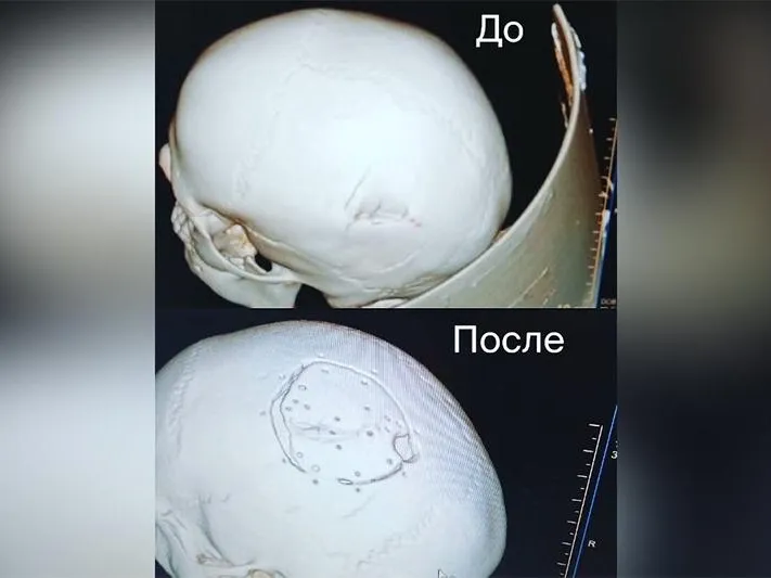 Медики Одинцово заново собрали череп мальчику, попавшему в аварию 