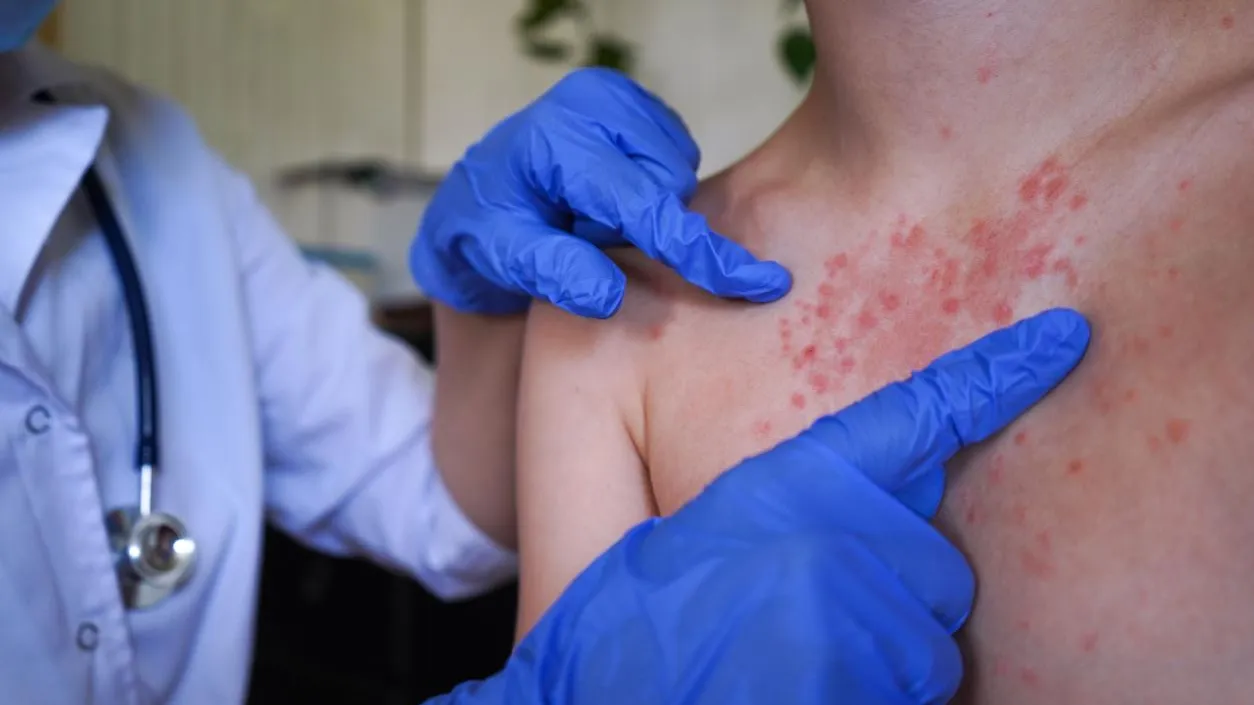 Корь вернулась: вирус идет через вентиляцию, грозит энцефалитом