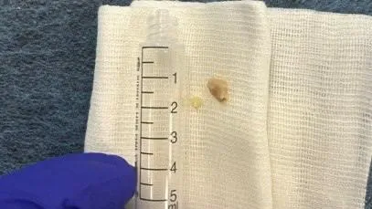 В Красногорске врачи Центра Рошаля извлекли орех из бронха ребенка