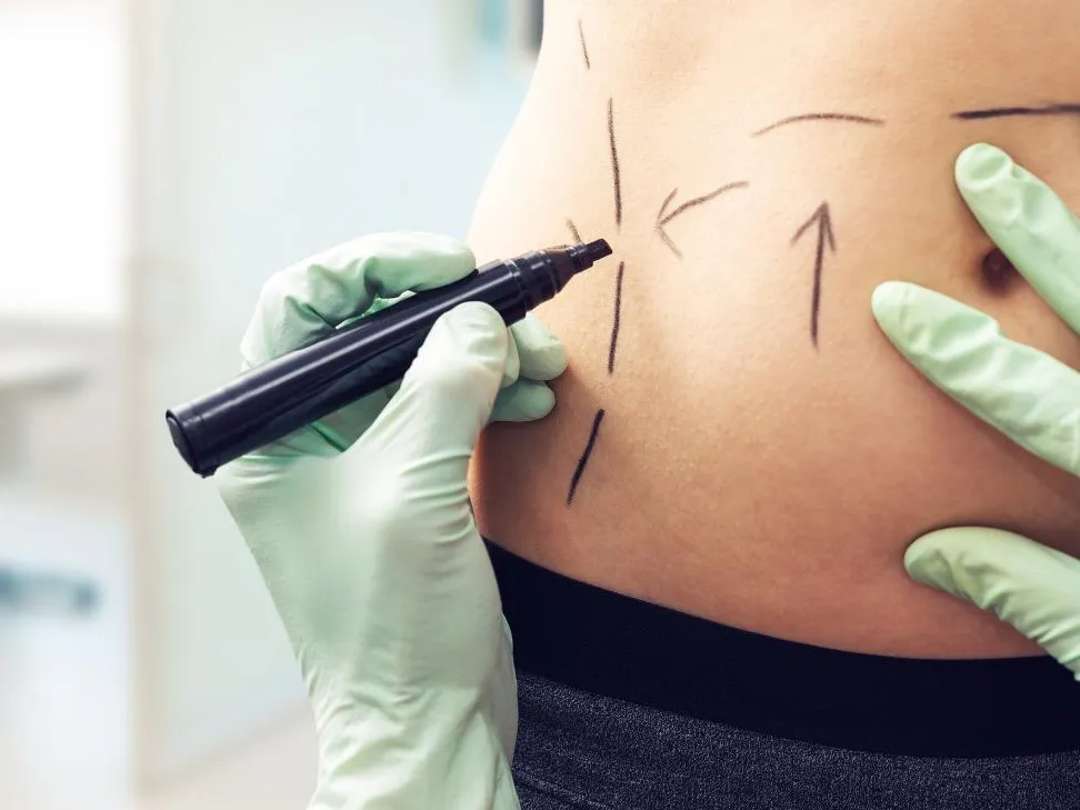 Удаление жира может убить: хирург рассказал о страшных последствиях липосакции