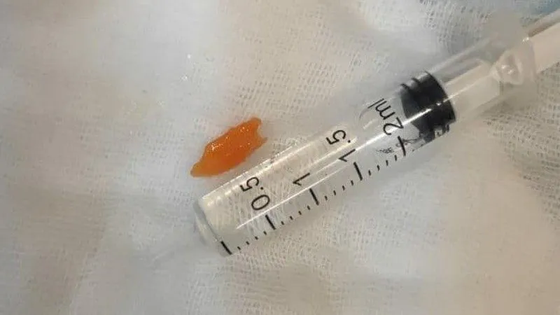 Врачи в Подмосковье вытащили кусок моркови из бронхов годовалой девочки