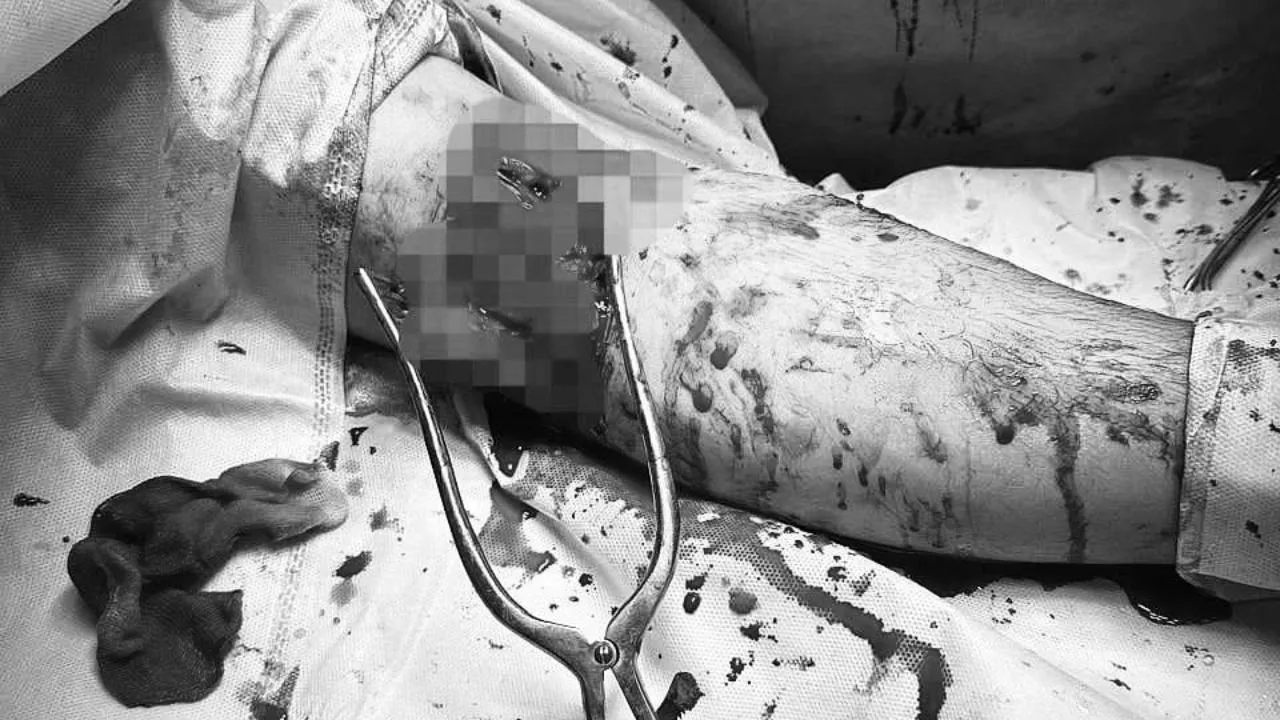 Врачи в Долгопрудном спасли молодого человека, перепилившего вместо дерева свою руку