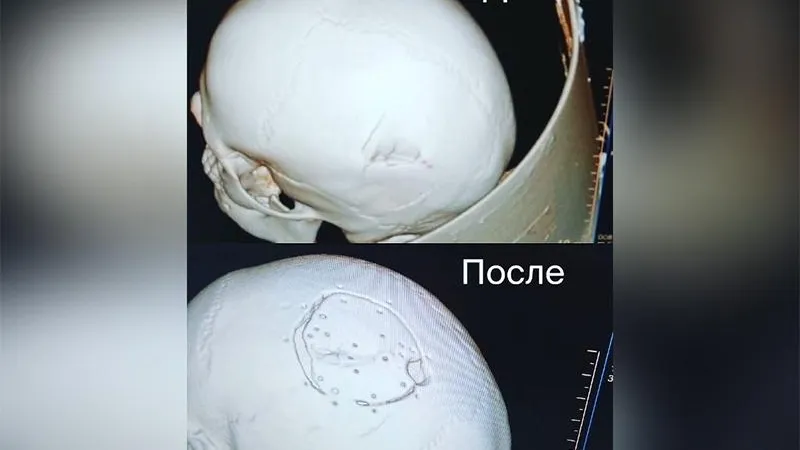 Медики Одинцово заново собрали череп мальчику, попавшему в аварию 